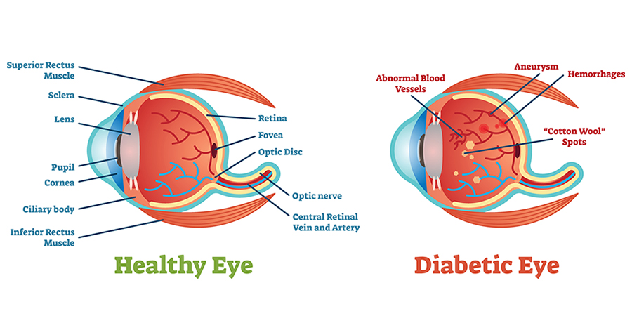 diabetic retinopathy treatment in Raj Nagar Extension, Ghaziabad