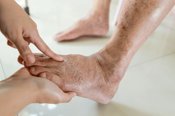 diabetic foot treatment in Raj Nagar Extension, Ghaziabad