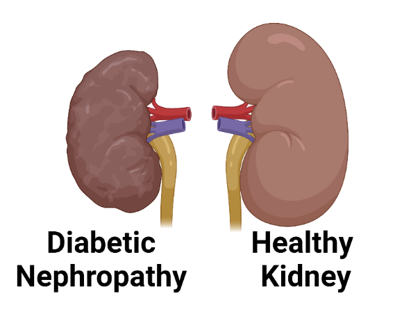 diabetic neuropathy treatment in Raj Nagar Extension, Ghaziabad