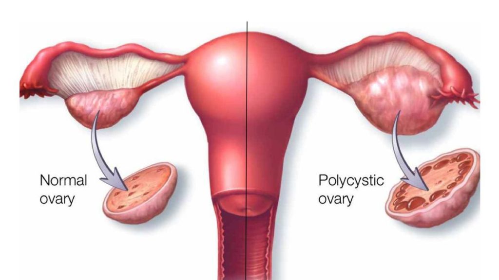 pcos and pcod treatment in Raj Nagar Extension, Ghaziabad