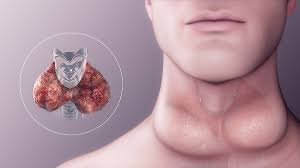 thyroid disorder treatment and management in Raj Nagar Extension, Ghaziabad